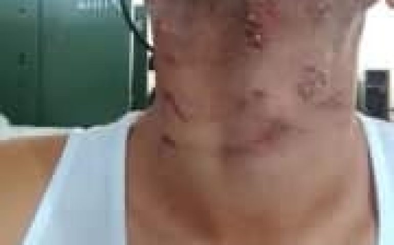 Parte das queimaduras sofridas pelo recruta da 9ª Companhia de Guarda (Foto: Divulgação)